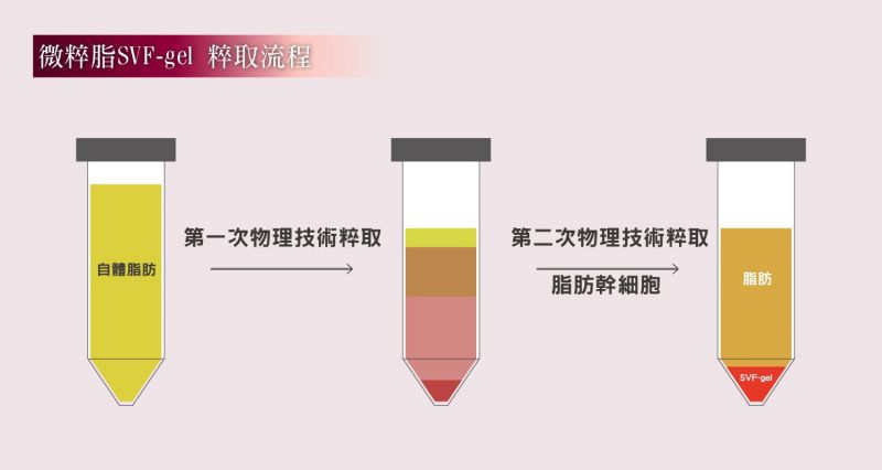 自体脂肪移植3.0微粹脂SVF-gel：改善老化细纹皱纹下垂