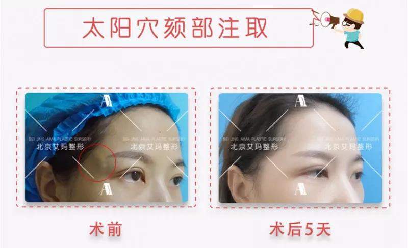 邓正军与丁小邦哪个取奥美定好？