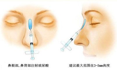 李文峰做鼻综合技术怎么样？李文峰鼻综合手术费用贵不贵？