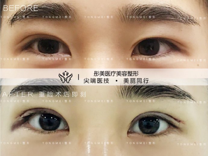 北京刘风卓、白永辉和王世勇谁修复双眼皮最好呢