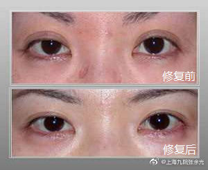 上海九院修复双眼皮专家都有谁？