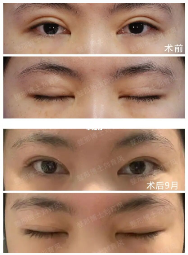 南京二院刘育凤和刘宁谁双眼皮修复技术好？