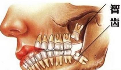 智齿一定要拔吗？智齿必须要拔掉吗？