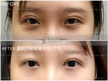 刘风卓和吴炎秋哪个双眼皮修复技术好？