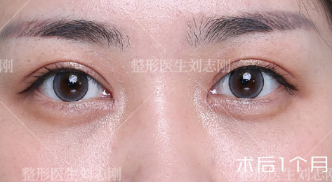 国内修复双眼皮权威专家排名