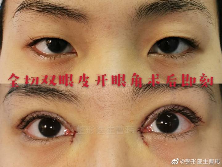 武汉同济曹玮割双眼皮怎么样