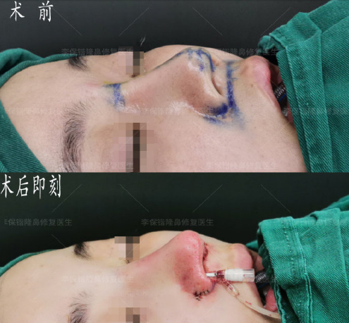 杭州鼻综合修复手术哪个医生好