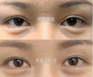 上海何祥龙双眼皮修复技术怎么样？