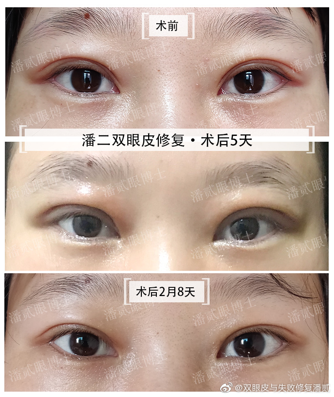 广州眼修复专家潘贰双眼皮修复技术怎么样？