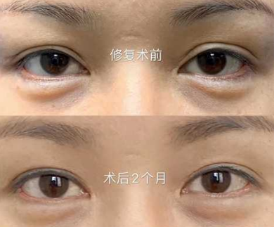 2022年长春双眼皮修复哪个专家最好？