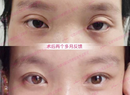 2022年郑州修复双眼皮最好的医生预约排行榜大全