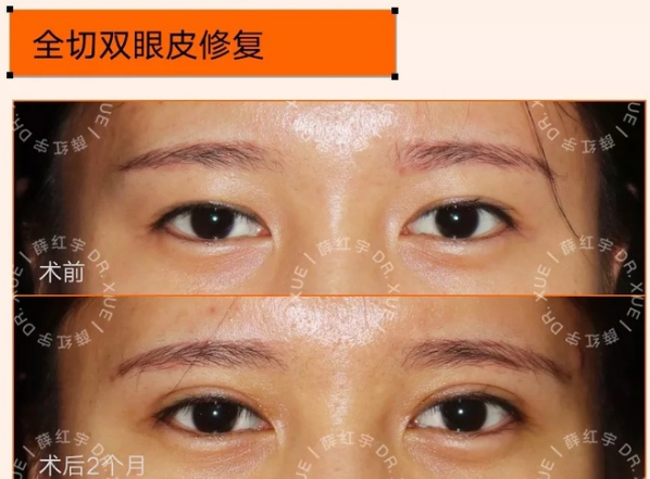 北医三院薛红宇修复双眼皮技术怎么样？