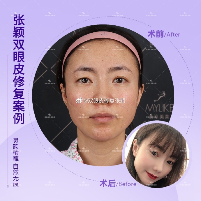 北京美莱张颖修复双眼皮技术怎么样？