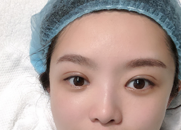 2022年天津哪个医生双眼皮修复做得最好？