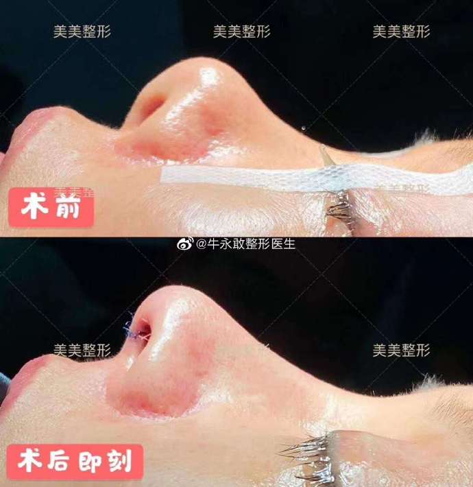 牛永敢修复鼻子怎么样