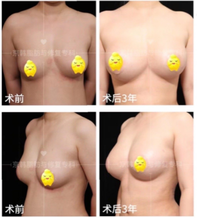 北京京韩王沛森做自体脂肪隆胸技术好吗？