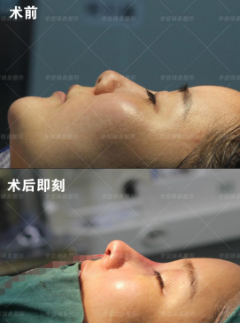 深圳隆鼻医生哪个好？深圳鼻子做得好的医生