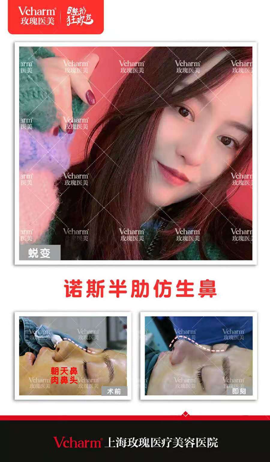 上海玫瑰医院哪个医生做的肋骨鼻好