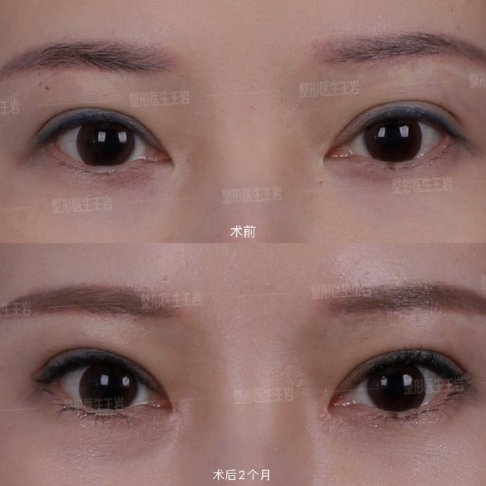 王岩医生做双眼皮修复怎样