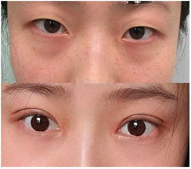 成都车红昌做双眼皮怎么样？车红昌做双眼皮修复吗？