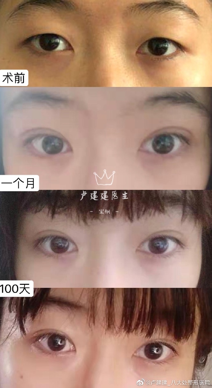 八大处医院哪个医生做眼综合好