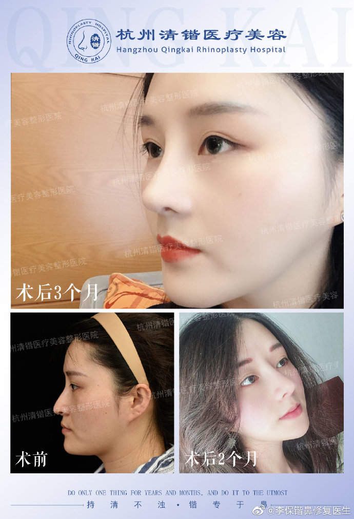 杭州李保锴鼻修复技术怎么样？效果好不好？