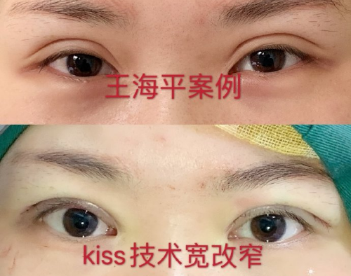 武汉王海平双眼皮修复技术怎么样