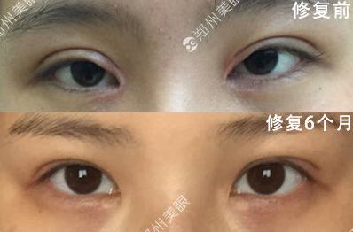 郑州眼角修复比较好的医生是谁