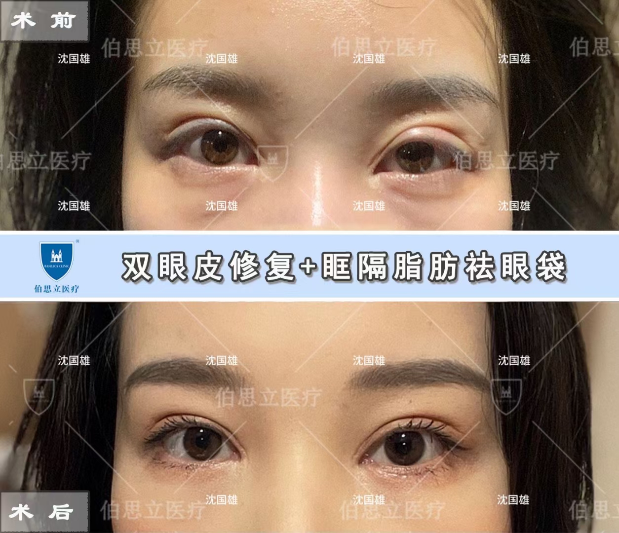 上海修复眼睛最好的医生是哪个