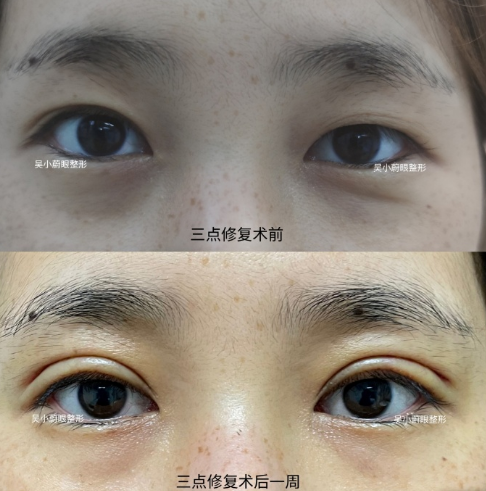 武汉做眼修复最好的专家是谁？