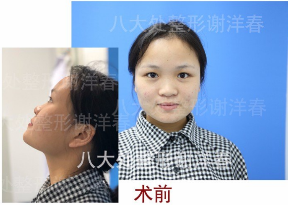 八大处谢洋春鼻综合技术怎么样
