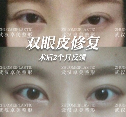 武汉双眼皮修复哪里做的比较好