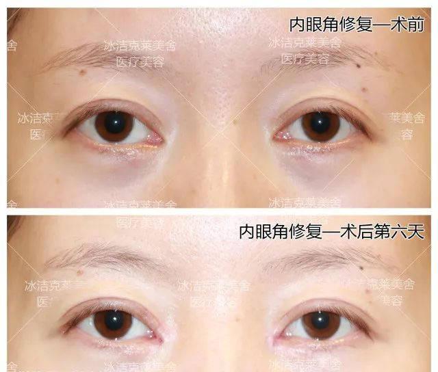 北京修复眼角厉害的医生是谁