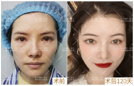 成都修复双眼皮权威医生是哪个