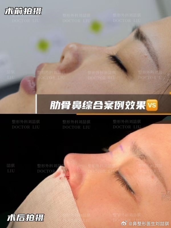 广州刘喆骐医生做的鼻子怎么样？刘喆骐隆鼻咨询预约电话