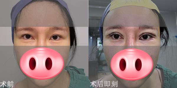 合肥双眼皮修复专家推荐哪个最好