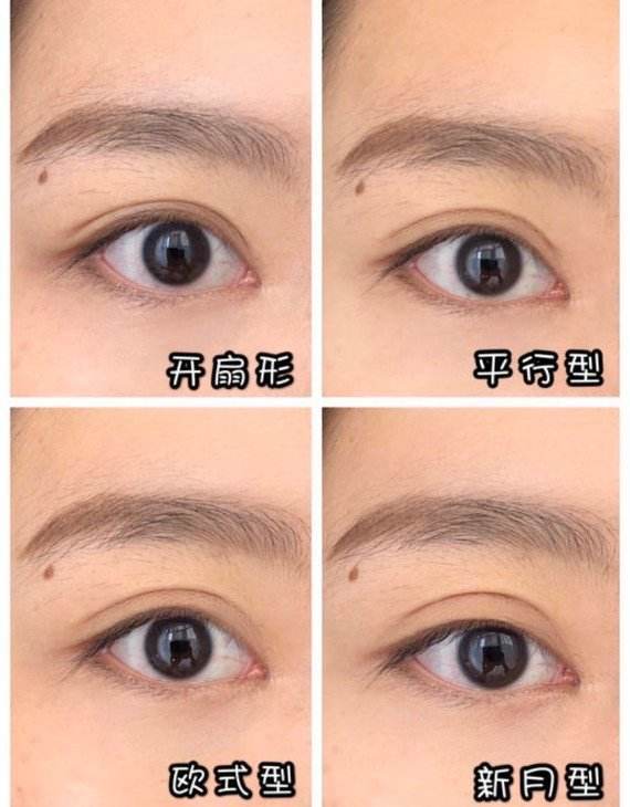 广西南宁割双眼皮哪个医生最出名
