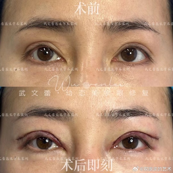 北京武文蕾修复双眼皮怎么样？武文蕾眼修复技术好吗？