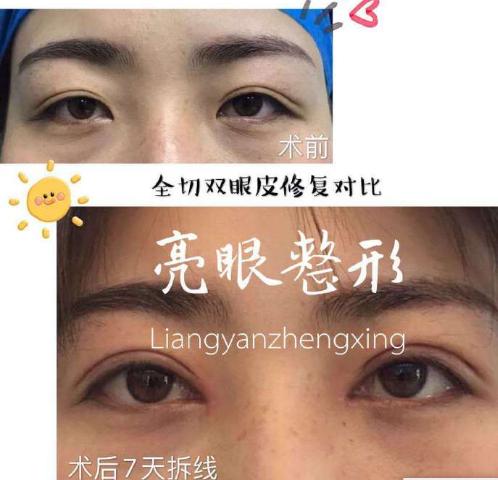 郑州贾亮修复双眼皮怎么样