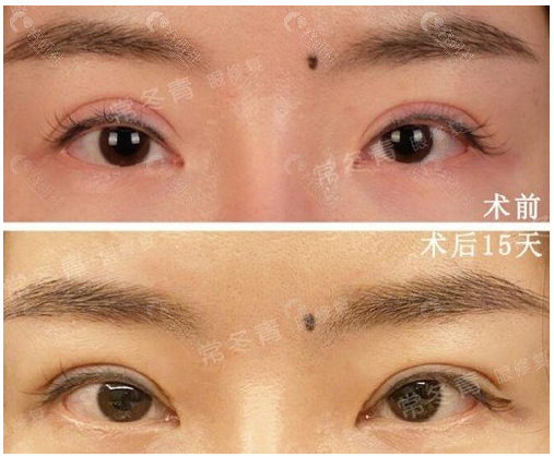 双眼皮修复常冬青和韩勋哪个好