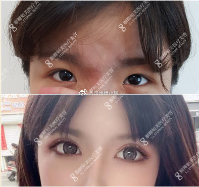 杨小顺和聂丽丽哪个做双眼皮好