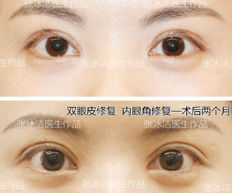 张冰洁和王振军内眼角谁修复的好