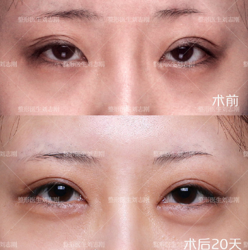 大连刘志刚眼部修复技术怎么样