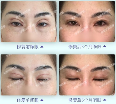 王振军和张冰洁修复眼角哪个最好