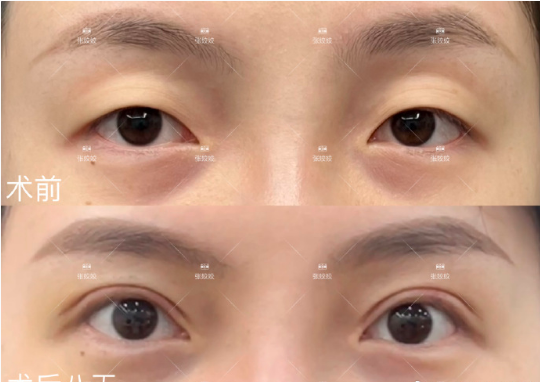 长沙张姣姣双眼皮做得怎么样？