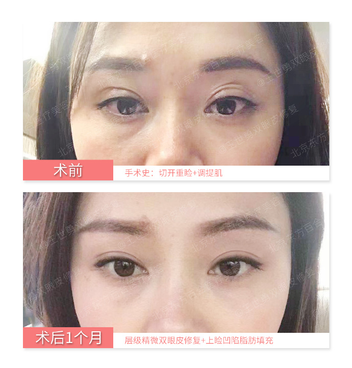 王世勇和杨明勇那个双眼皮修复好？