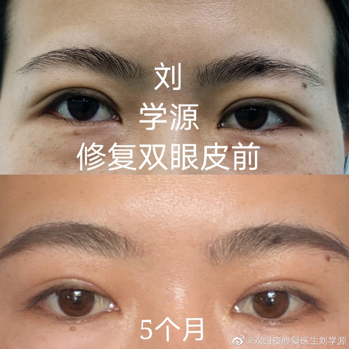 双眼皮修复刘学源和刘辅容哪个修复好