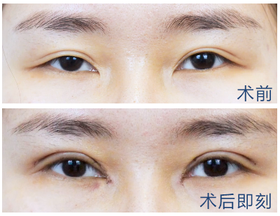 郑州修复双眼皮哪个医生好