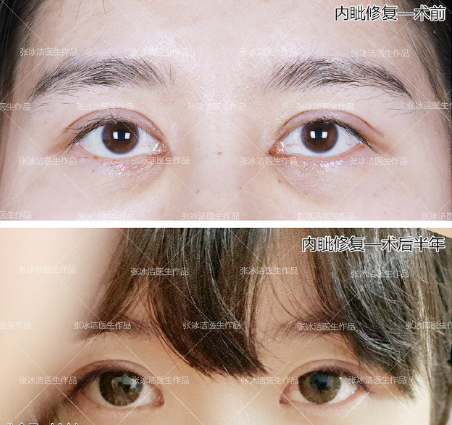王世勇和张冰洁眼角修复哪个好