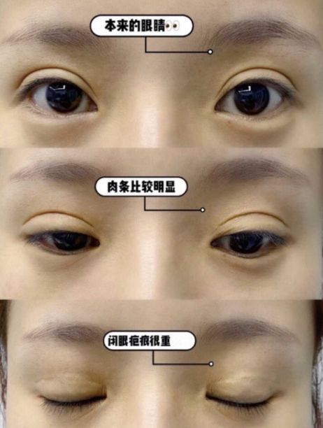 广州可玉张克医生眼修复怎么样